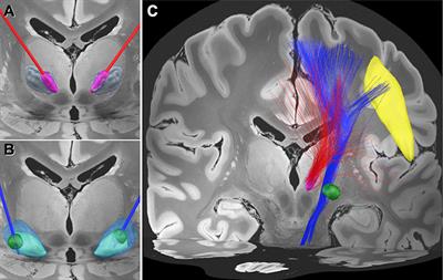 Case Report: GPi DBS for Non-parkinsonian Midline Tremor: A Normative Connectomic Comparison to a Failed Thalamic DBS